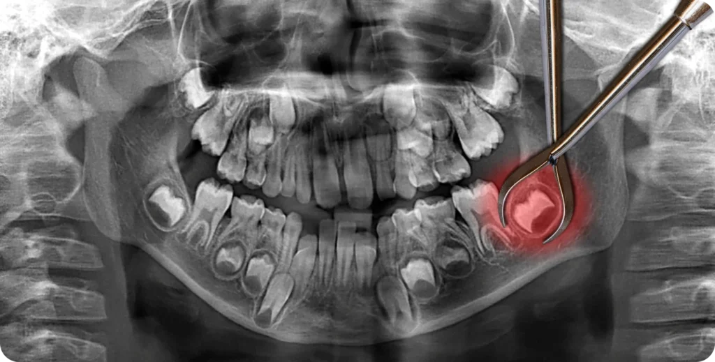 Degagement des dents incluses