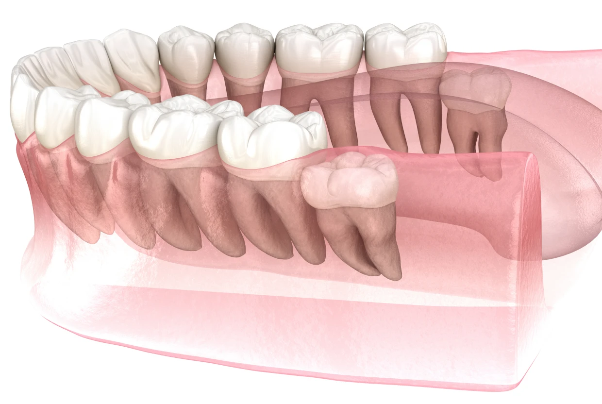 Extraction dents de sagesse