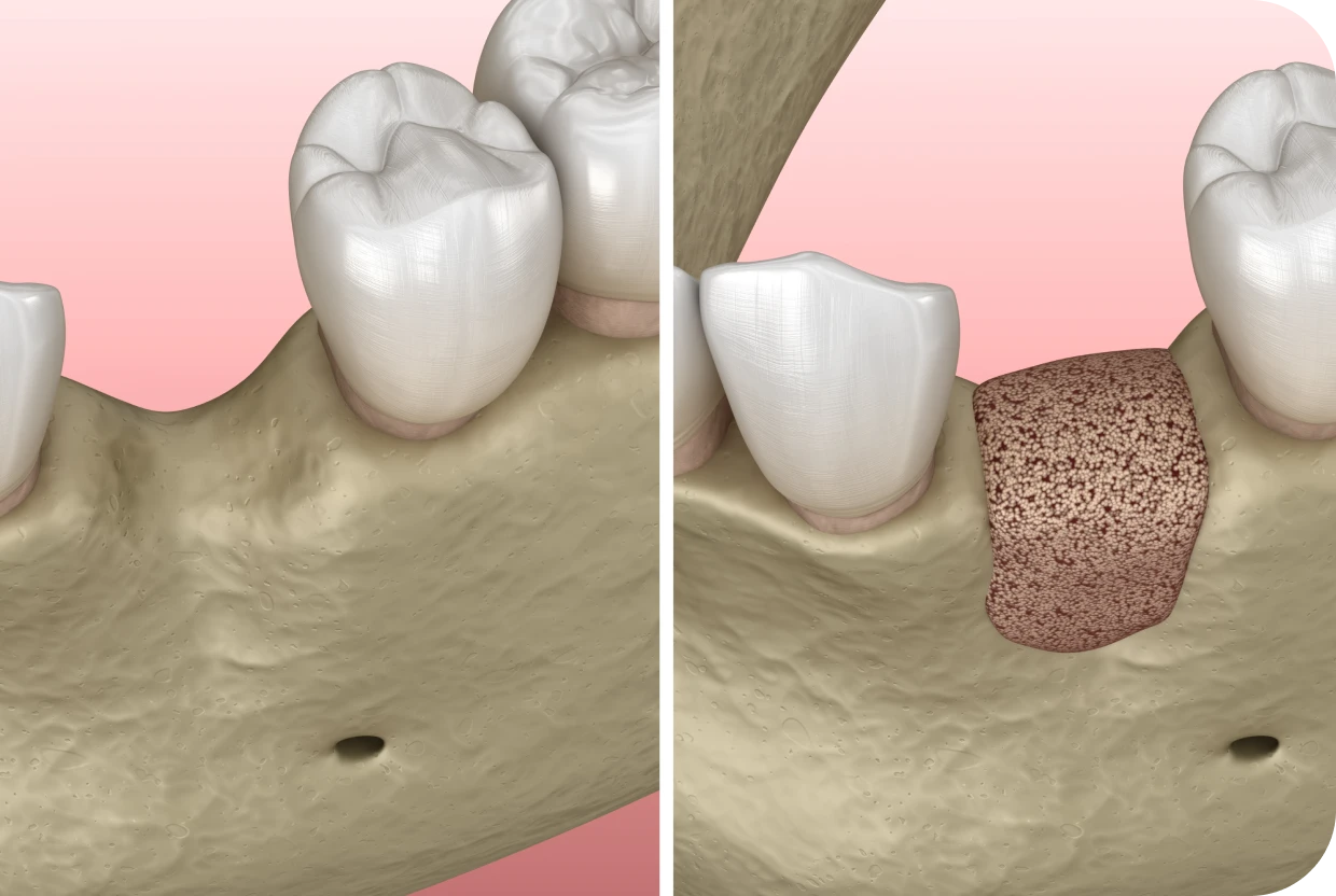 greffe ossuese apposition avant implant levallois-perret