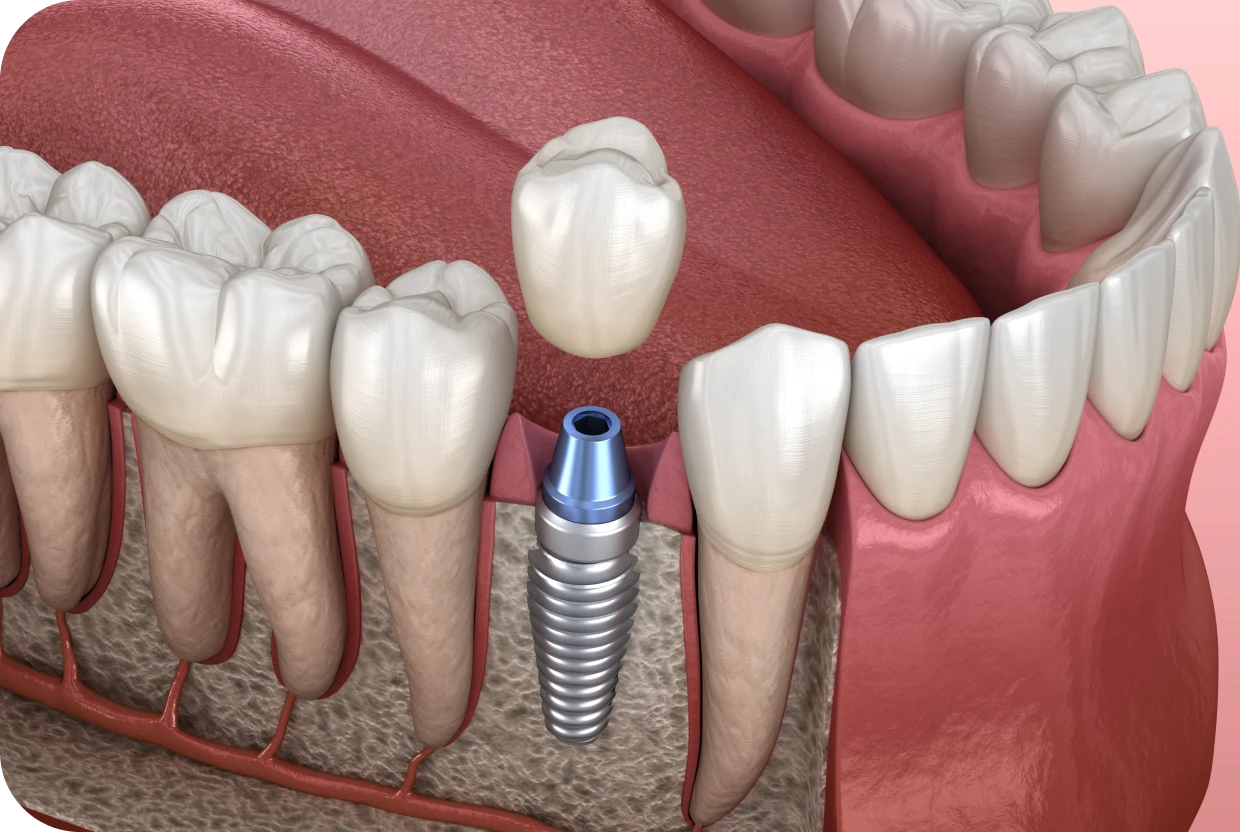 Implant unitaire