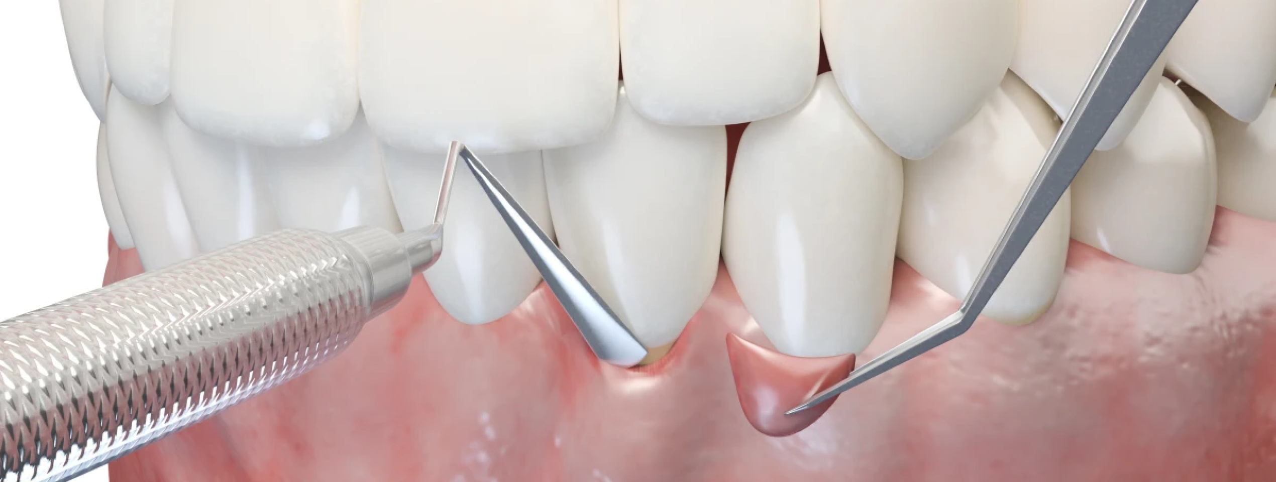 Module 3 : Chirurgie muco gingivale