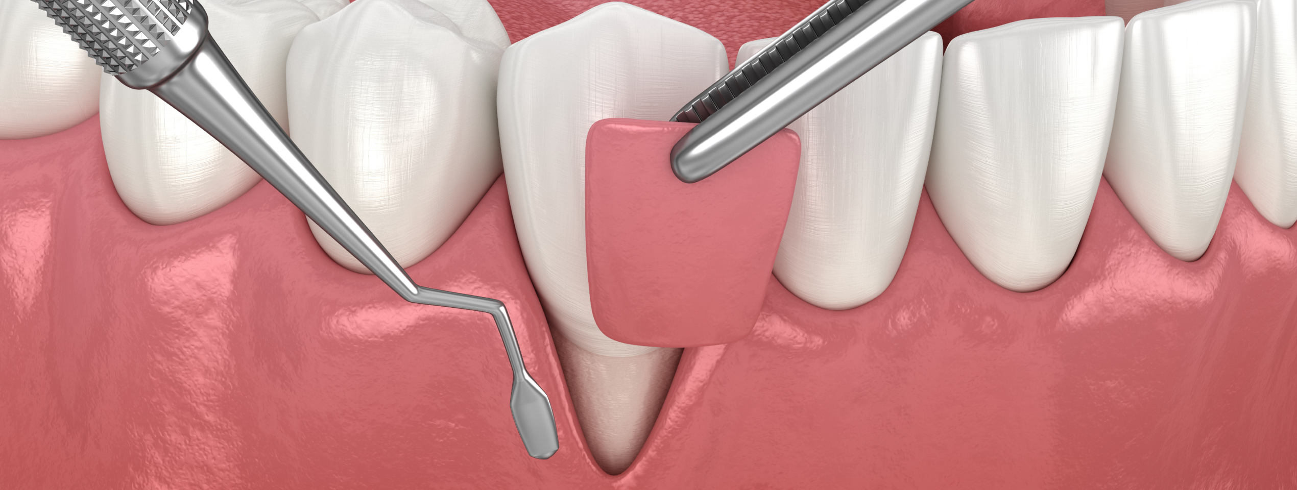 Module 2 : Parodontie Chirurgicale